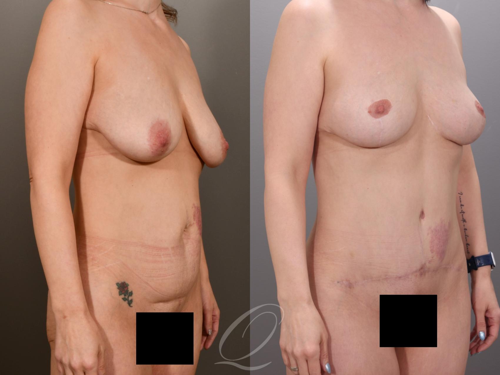 Mommy Makeover Case 1001973 Before & After Right Oblique | Serving Rochester, Syracuse & Buffalo, NY | Quatela Center for Plastic Surgery