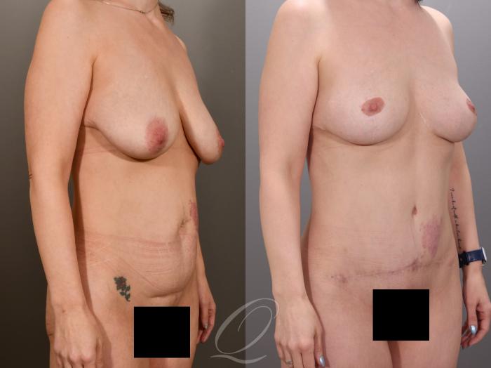Mommy Makeover Case 1001973 Before & After Right Oblique | Serving Rochester, Syracuse & Buffalo, NY | Quatela Center for Plastic Surgery