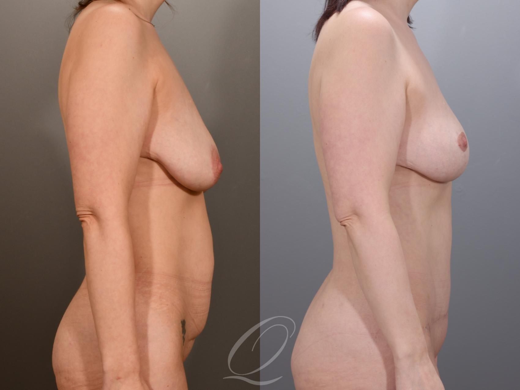 Mommy Makeover Case 1001973 Before & After Right Side | Serving Rochester, Syracuse & Buffalo, NY | Quatela Center for Plastic Surgery