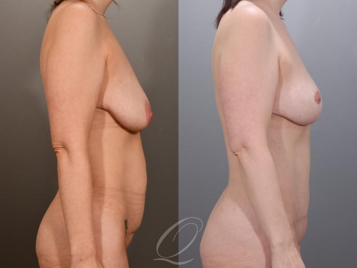 Mommy Makeover Case 1001973 Before & After Right Side | Serving Rochester, Syracuse & Buffalo, NY | Quatela Center for Plastic Surgery