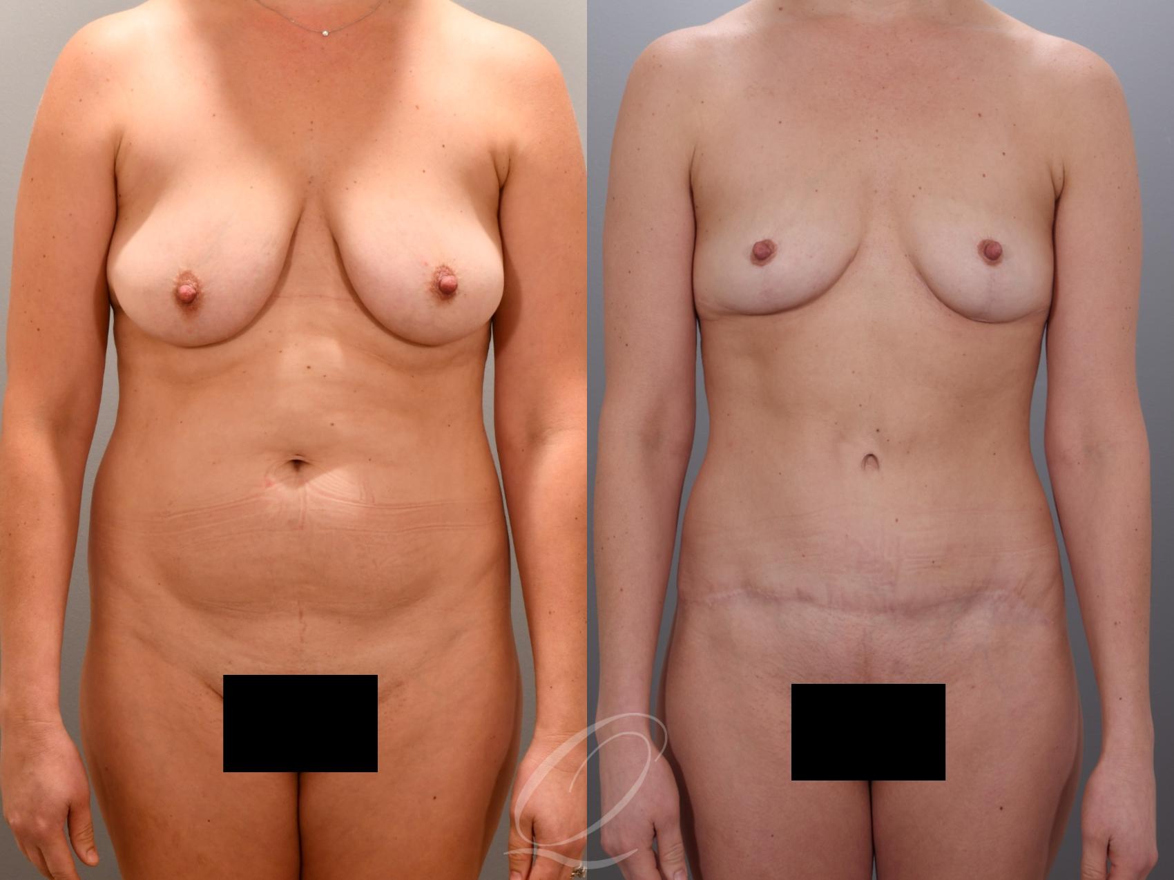Mommy Makeover Case 1001974 Before & After Front | Serving Rochester, Syracuse & Buffalo, NY | Quatela Center for Plastic Surgery