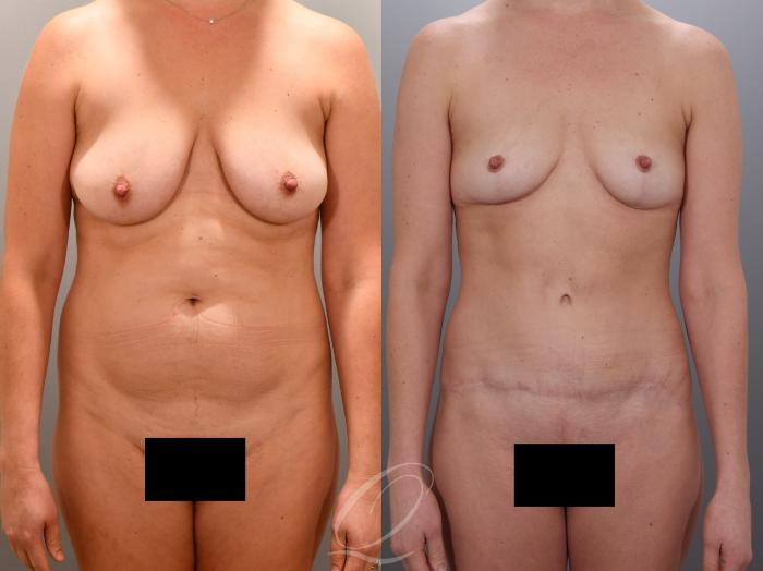 Mommy Makeover Case 1001974 Before & After Front | Serving Rochester, Syracuse & Buffalo, NY | Quatela Center for Plastic Surgery
