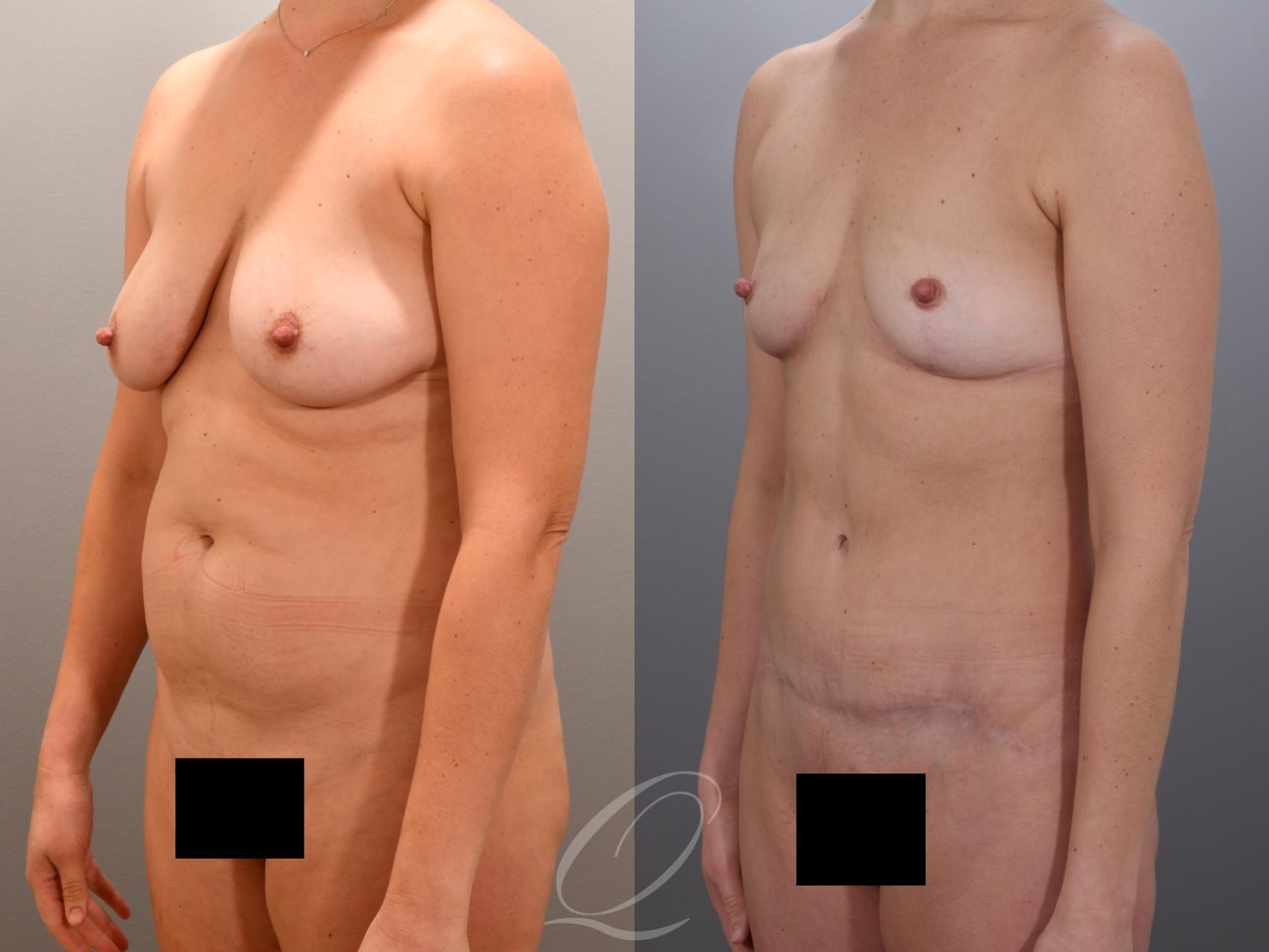 Mommy Makeover Case 1001974 Before & After Left Oblique | Serving Rochester, Syracuse & Buffalo, NY | Quatela Center for Plastic Surgery