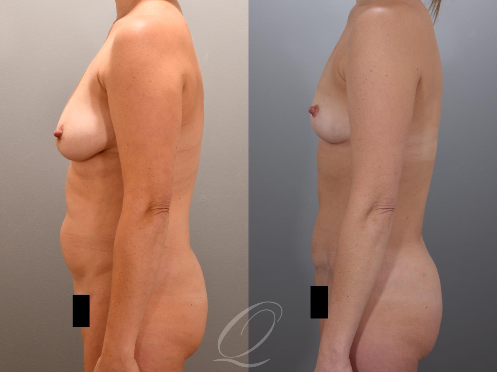 Mommy Makeover Case 1001974 Before & After Left Side | Serving Rochester, Syracuse & Buffalo, NY | Quatela Center for Plastic Surgery