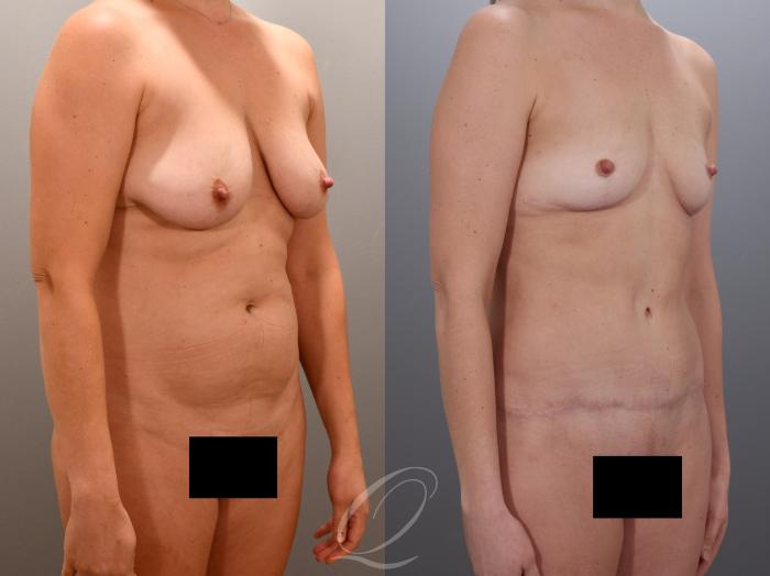 Mommy Makeover Case 1001974 Before & After Right Oblique | Serving Rochester, Syracuse & Buffalo, NY | Quatela Center for Plastic Surgery