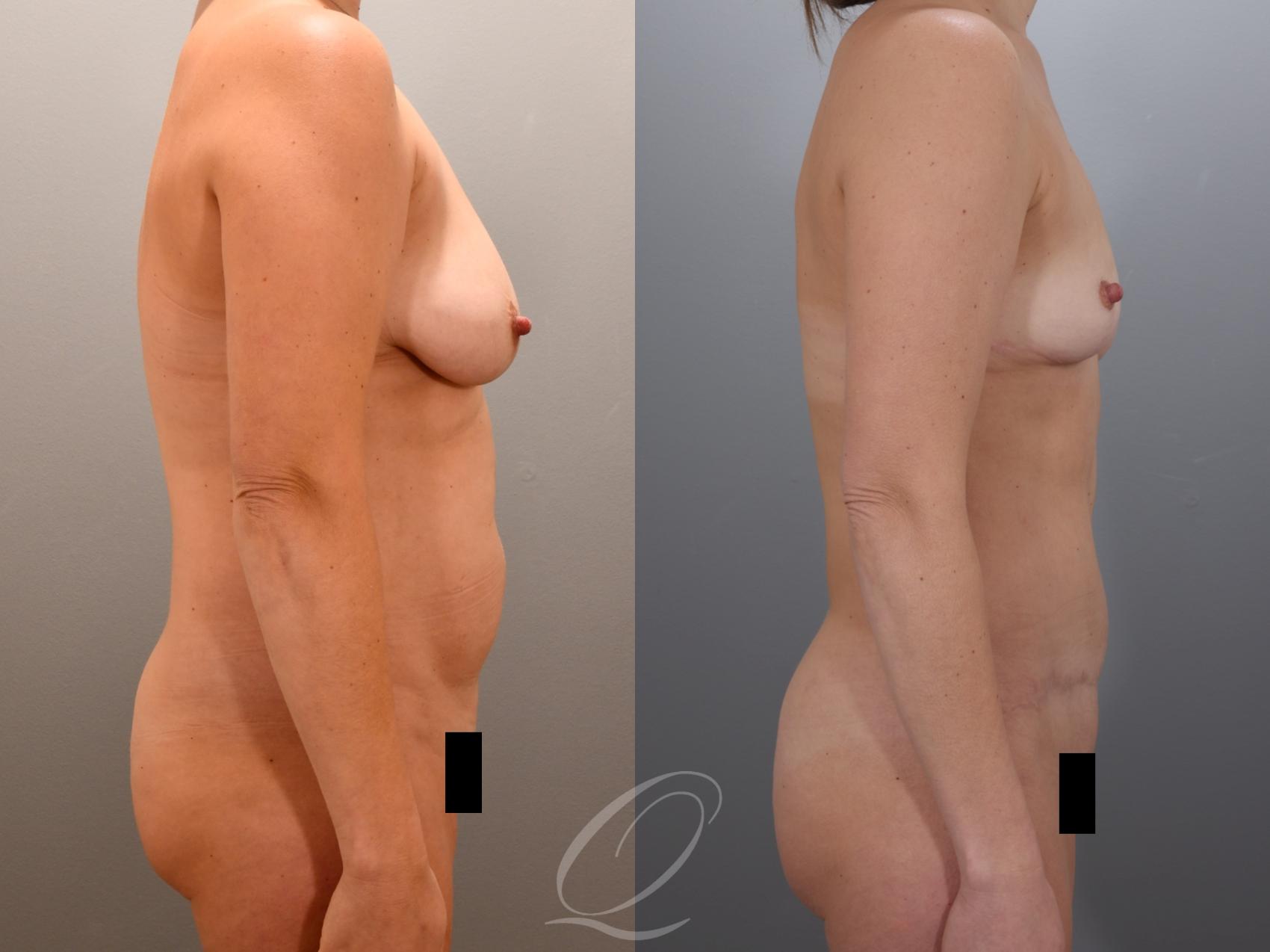 Mommy Makeover Case 1001974 Before & After Right Side | Serving Rochester, Syracuse & Buffalo, NY | Quatela Center for Plastic Surgery