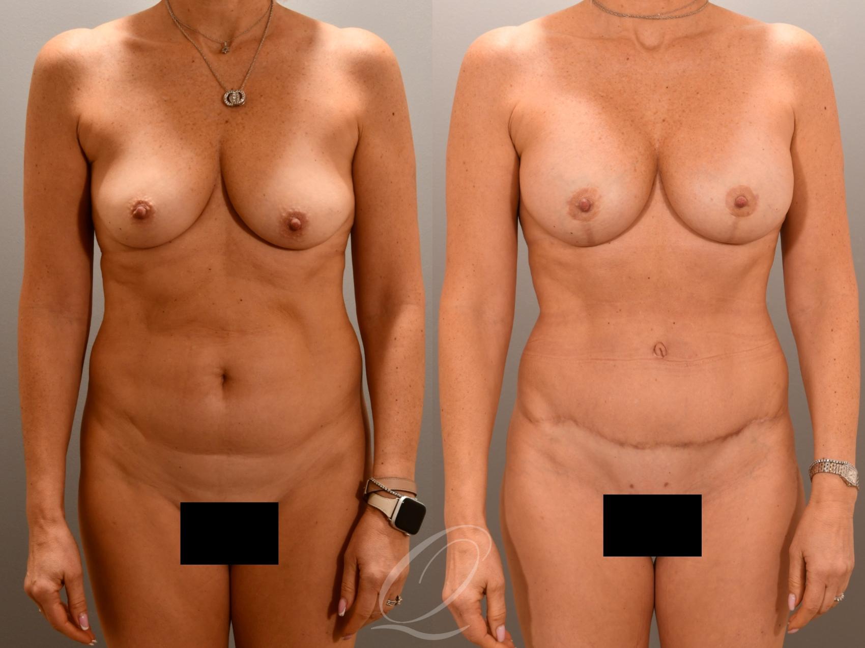 Mommy Makeover Case 1001976 Before & After Front | Serving Rochester, Syracuse & Buffalo, NY | Quatela Center for Plastic Surgery