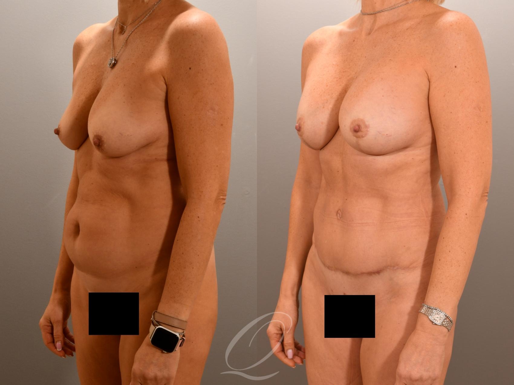 Mommy Makeover Case 1001976 Before & After Left Oblique | Serving Rochester, Syracuse & Buffalo, NY | Quatela Center for Plastic Surgery