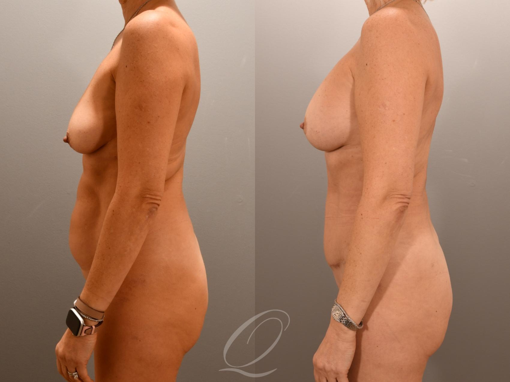 Mommy Makeover Case 1001976 Before & After Left Side | Serving Rochester, Syracuse & Buffalo, NY | Quatela Center for Plastic Surgery