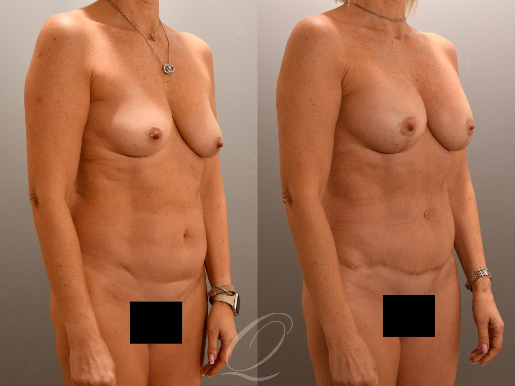 Mommy Makeover Case 1001976 Before & After Right Oblique | Serving Rochester, Syracuse & Buffalo, NY | Quatela Center for Plastic Surgery