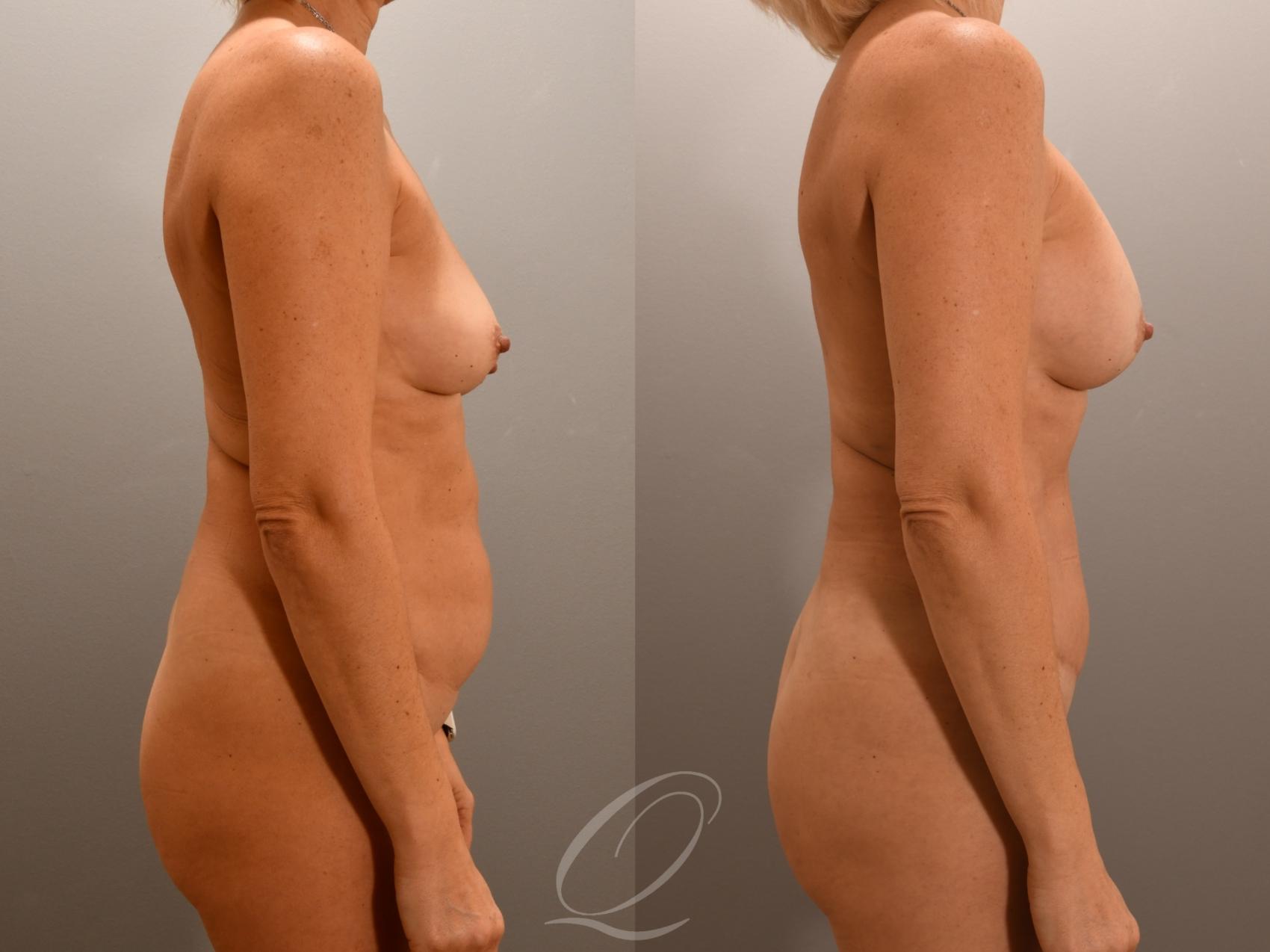 Mommy Makeover Case 1001976 Before & After Right Side | Serving Rochester, Syracuse & Buffalo, NY | Quatela Center for Plastic Surgery