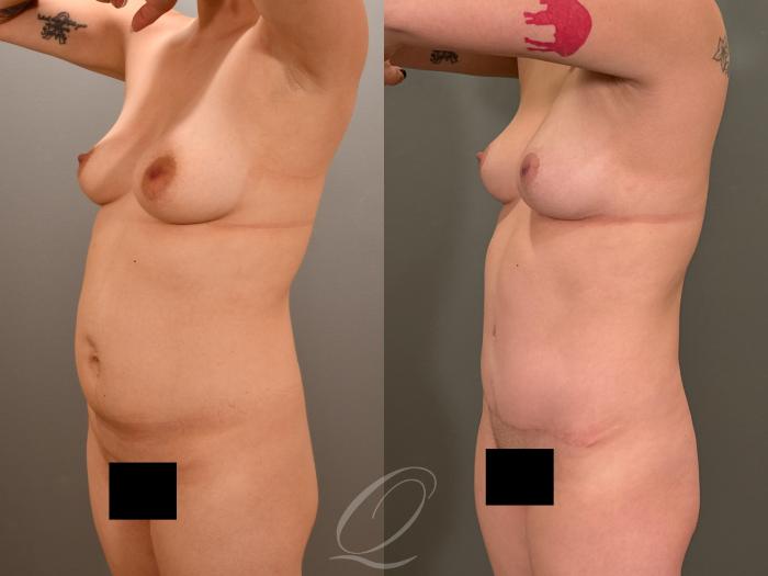 Mommy Makeover Case 1001977 Before & After Left Oblique | Serving Rochester, Syracuse & Buffalo, NY | Quatela Center for Plastic Surgery