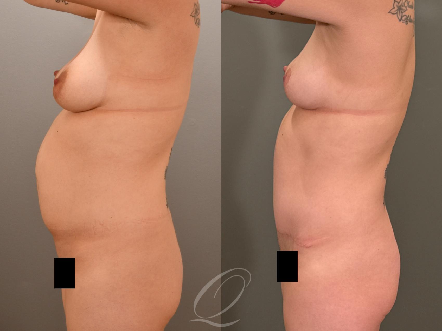 Mommy Makeover Case 1001977 Before & After Left Side | Serving Rochester, Syracuse & Buffalo, NY | Quatela Center for Plastic Surgery