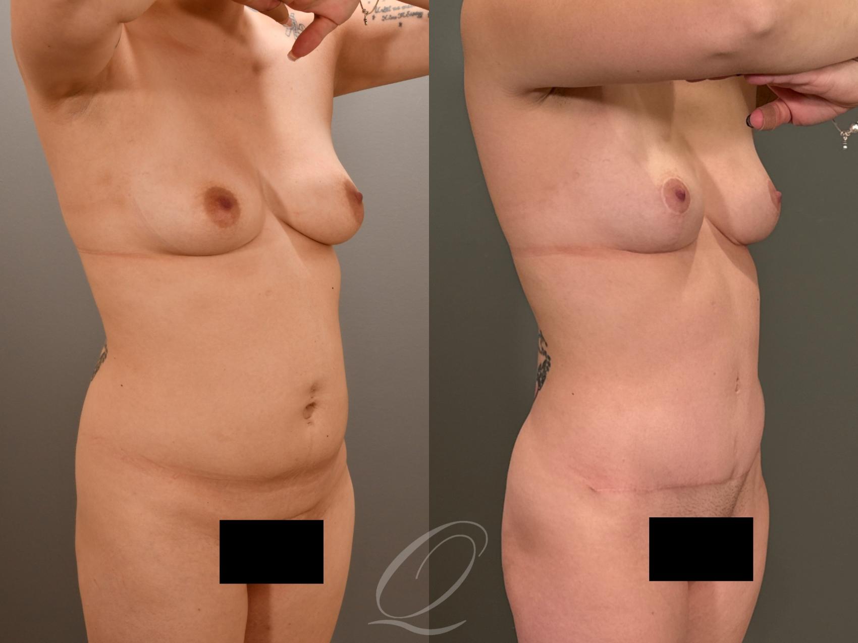Mommy Makeover Case 1001977 Before & After Right Oblique | Serving Rochester, Syracuse & Buffalo, NY | Quatela Center for Plastic Surgery