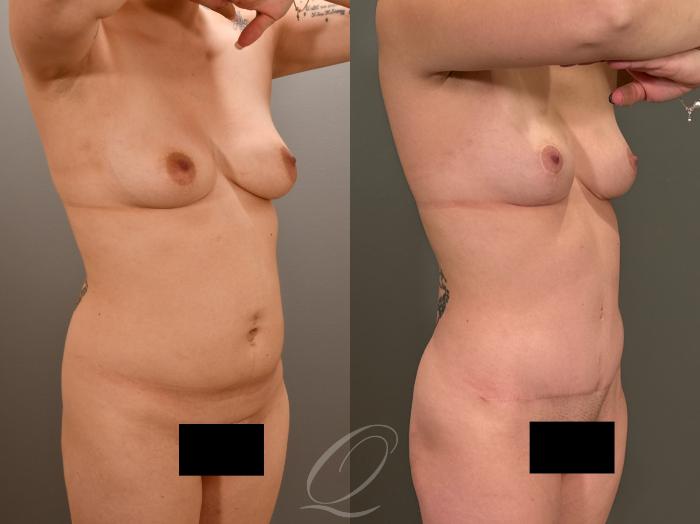 Mommy Makeover Case 1001977 Before & After Right Oblique | Serving Rochester, Syracuse & Buffalo, NY | Quatela Center for Plastic Surgery