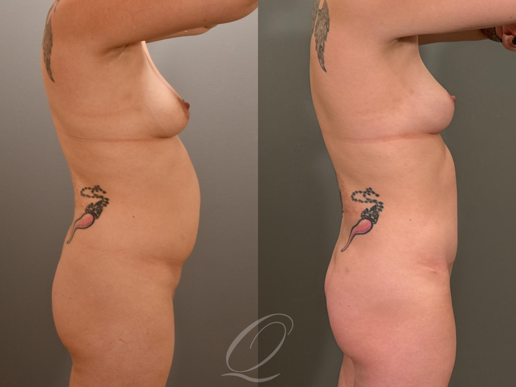 Mommy Makeover Case 1001977 Before & After Right Side | Serving Rochester, Syracuse & Buffalo, NY | Quatela Center for Plastic Surgery