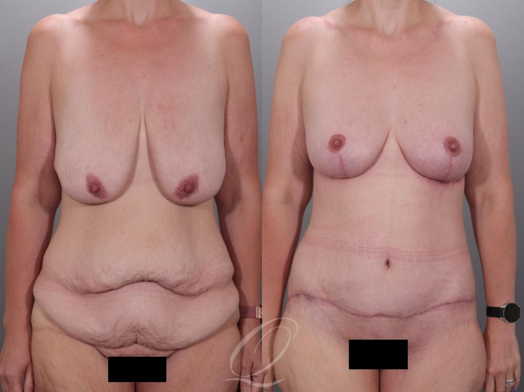 Mommy Makeover Case 1001978 Before & After Front | Serving Rochester, Syracuse & Buffalo, NY | Quatela Center for Plastic Surgery