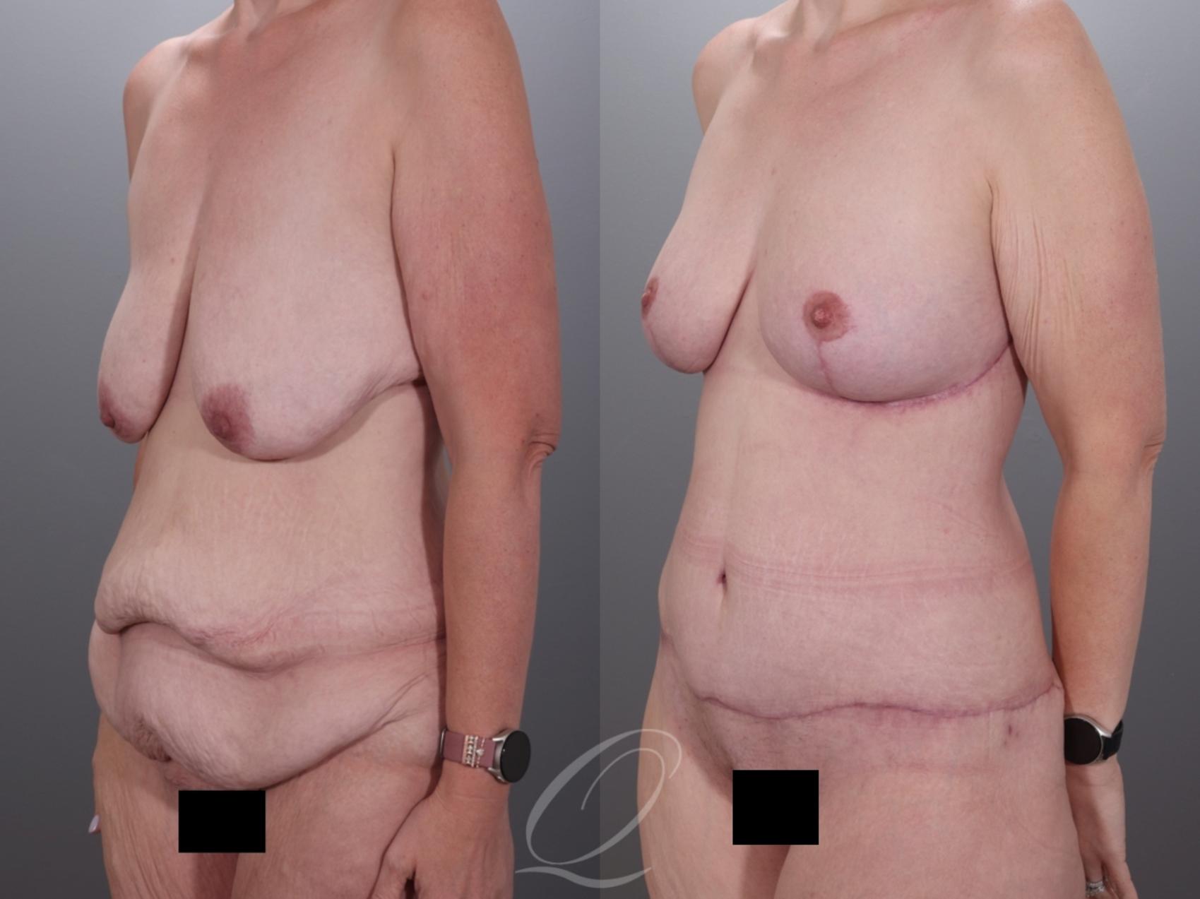 Mommy Makeover Case 1001978 Before & After Left Oblique | Serving Rochester, Syracuse & Buffalo, NY | Quatela Center for Plastic Surgery