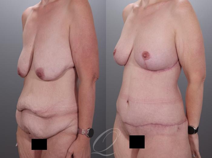 Mommy Makeover Case 1001978 Before & After Left Oblique | Serving Rochester, Syracuse & Buffalo, NY | Quatela Center for Plastic Surgery