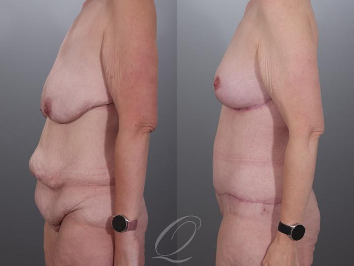 Mommy Makeover Case 1001978 Before & After Left Side | Serving Rochester, Syracuse & Buffalo, NY | Quatela Center for Plastic Surgery