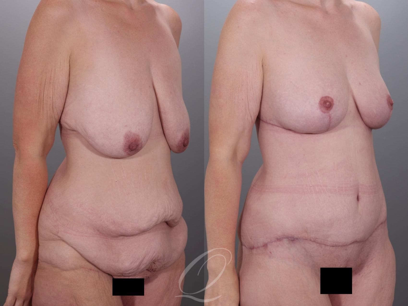 Mommy Makeover Case 1001978 Before & After Right Oblique | Serving Rochester, Syracuse & Buffalo, NY | Quatela Center for Plastic Surgery