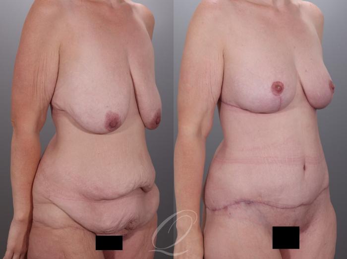 Mommy Makeover Case 1001978 Before & After Right Oblique | Serving Rochester, Syracuse & Buffalo, NY | Quatela Center for Plastic Surgery