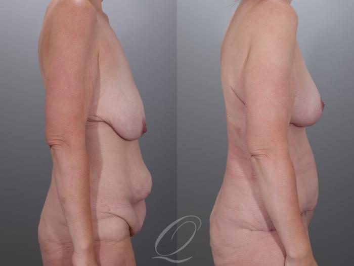 Mommy Makeover Case 1001978 Before & After Right Side | Serving Rochester, Syracuse & Buffalo, NY | Quatela Center for Plastic Surgery