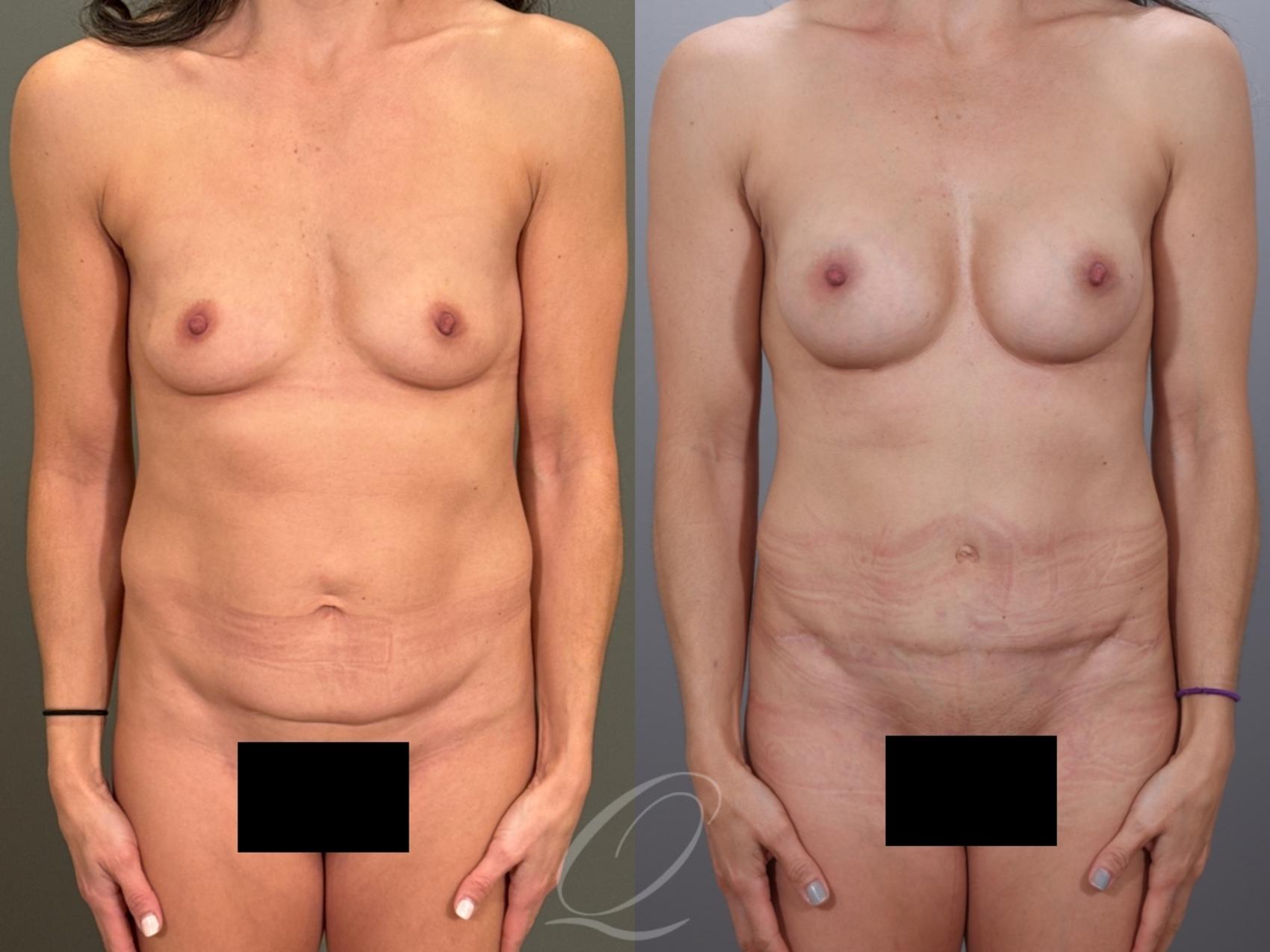 Mommy Makeover Case 1001979 Before & After Front | Serving Rochester, Syracuse & Buffalo, NY | Quatela Center for Plastic Surgery