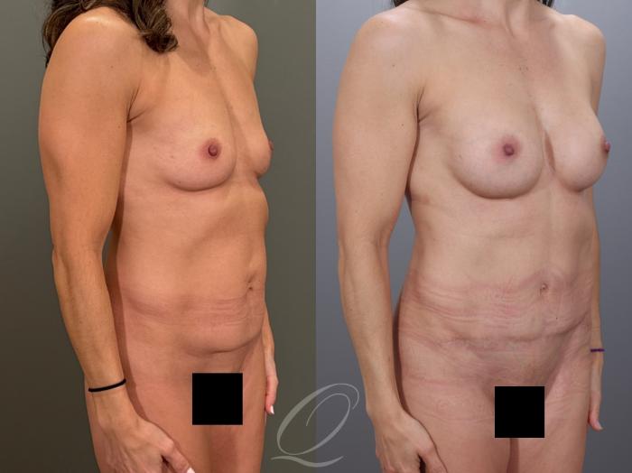 Mommy Makeover Case 1001979 Before & After Left Oblique | Serving Rochester, Syracuse & Buffalo, NY | Quatela Center for Plastic Surgery