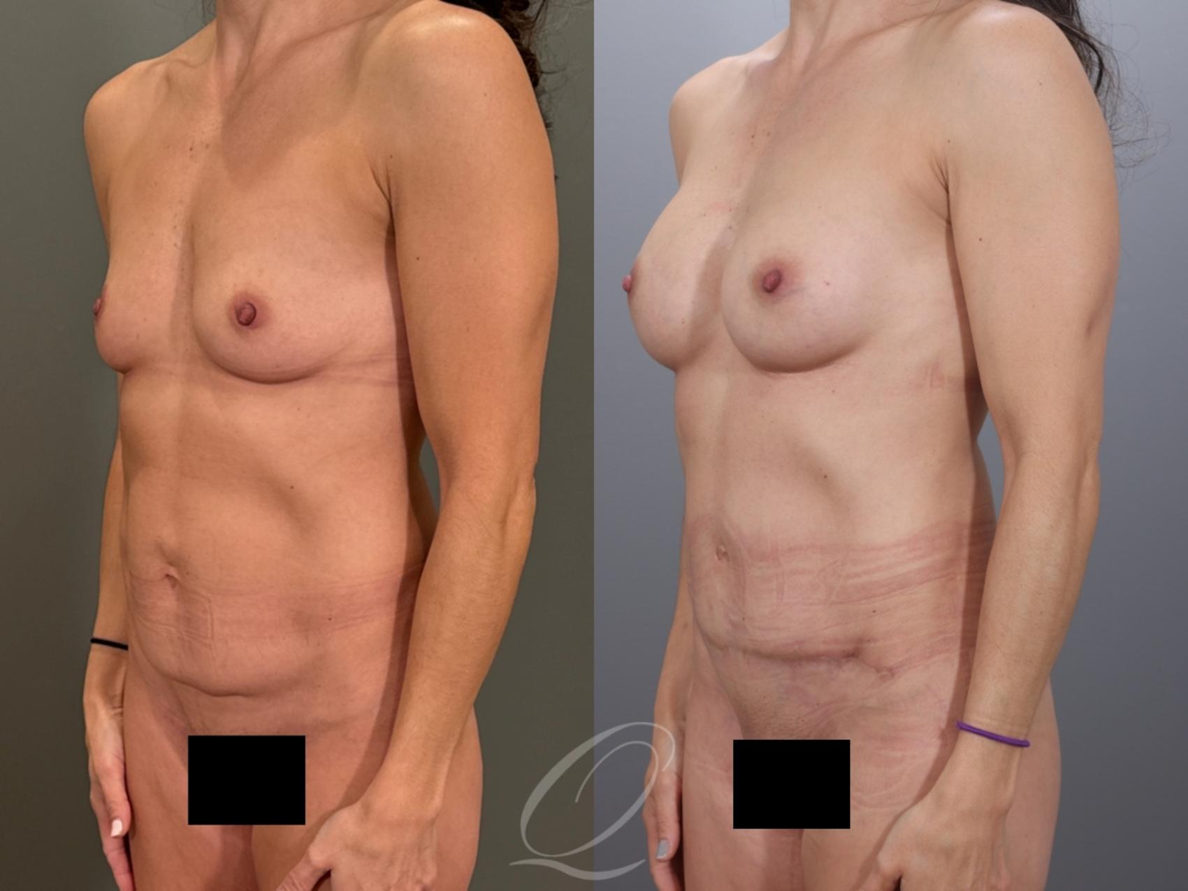 Mommy Makeover Case 1001979 Before & After Right Oblique | Serving Rochester, Syracuse & Buffalo, NY | Quatela Center for Plastic Surgery
