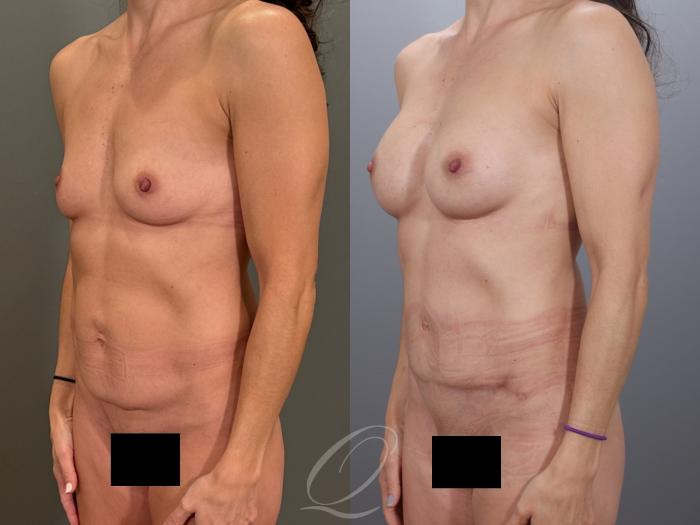 Mommy Makeover Case 1001979 Before & After Right Oblique | Serving Rochester, Syracuse & Buffalo, NY | Quatela Center for Plastic Surgery