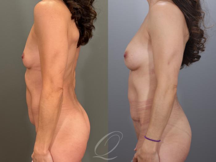 Mommy Makeover Case 1001979 Before & After Right Side | Serving Rochester, Syracuse & Buffalo, NY | Quatela Center for Plastic Surgery