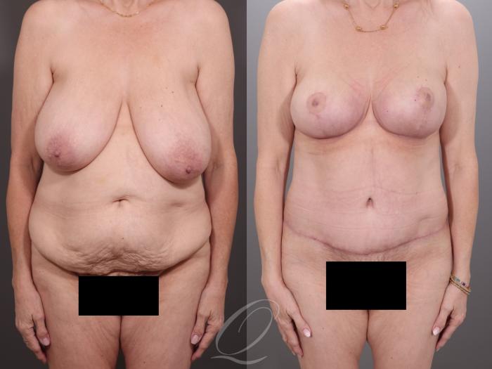Mommy Makeover Case 1001994 Before & After Front | Serving Rochester, Syracuse & Buffalo, NY | Quatela Center for Plastic Surgery