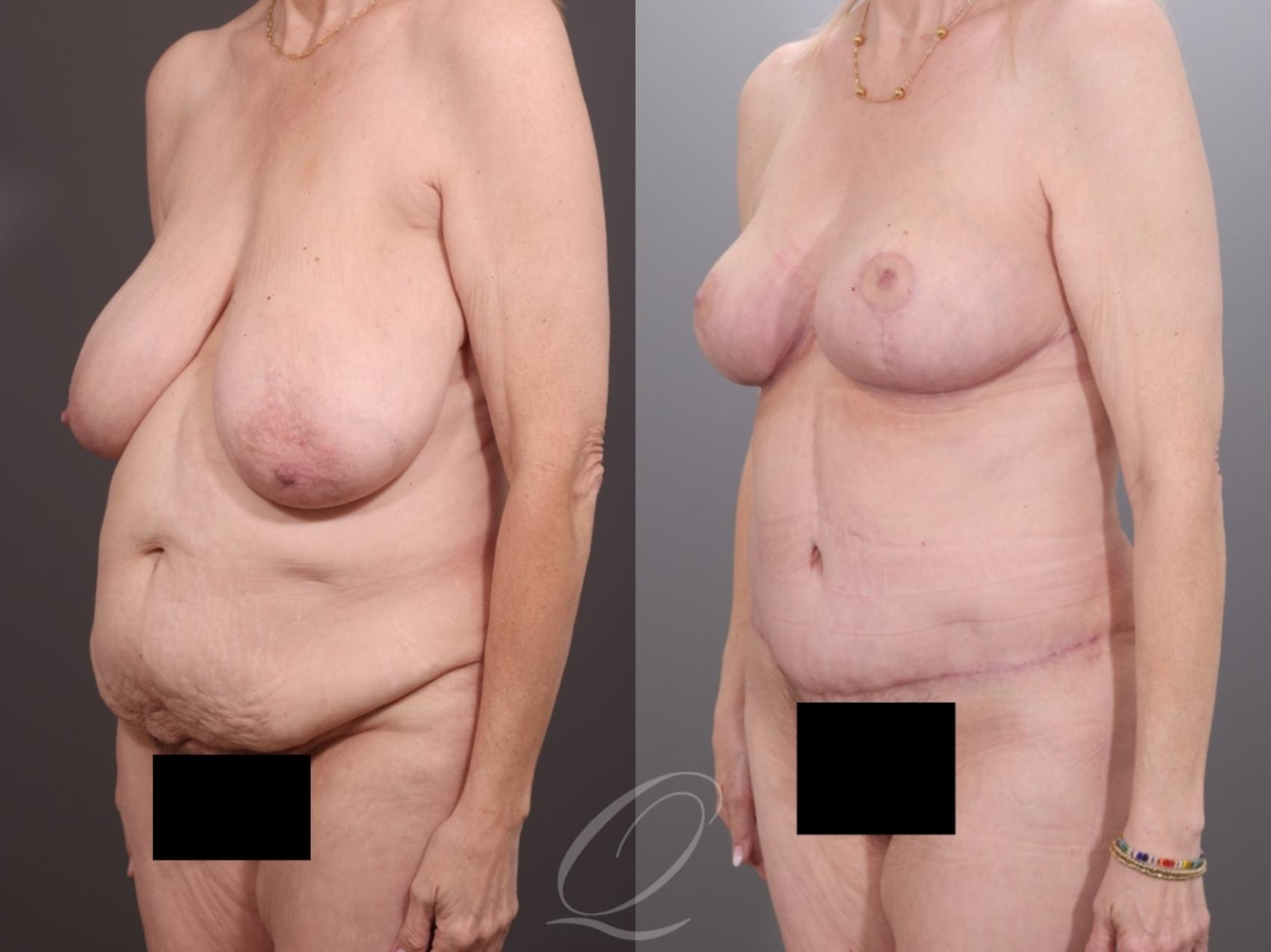 Mommy Makeover Case 1001994 Before & After Left Oblique | Serving Rochester, Syracuse & Buffalo, NY | Quatela Center for Plastic Surgery
