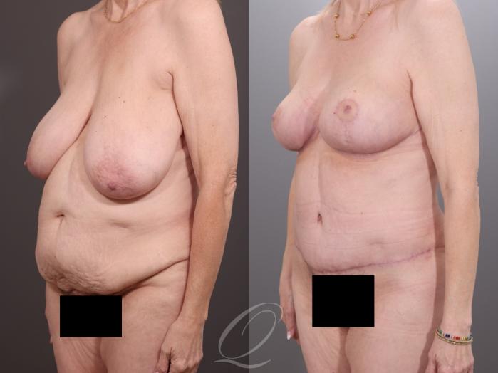Mommy Makeover Case 1001994 Before & After Left Oblique | Serving Rochester, Syracuse & Buffalo, NY | Quatela Center for Plastic Surgery