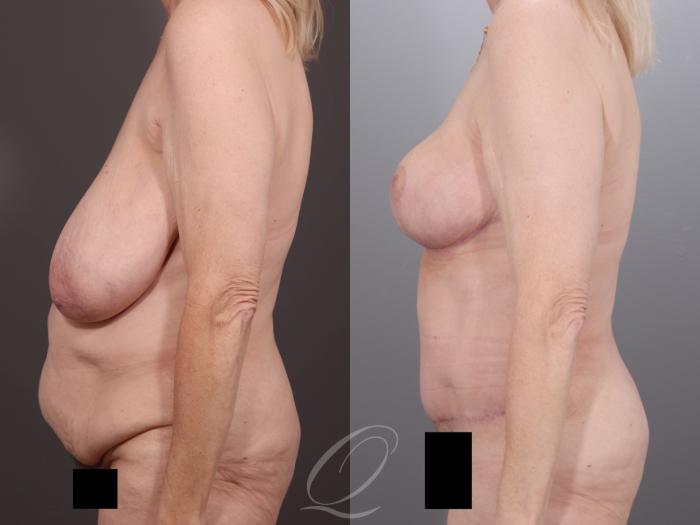 Mommy Makeover Case 1001994 Before & After Left Side | Serving Rochester, Syracuse & Buffalo, NY | Quatela Center for Plastic Surgery