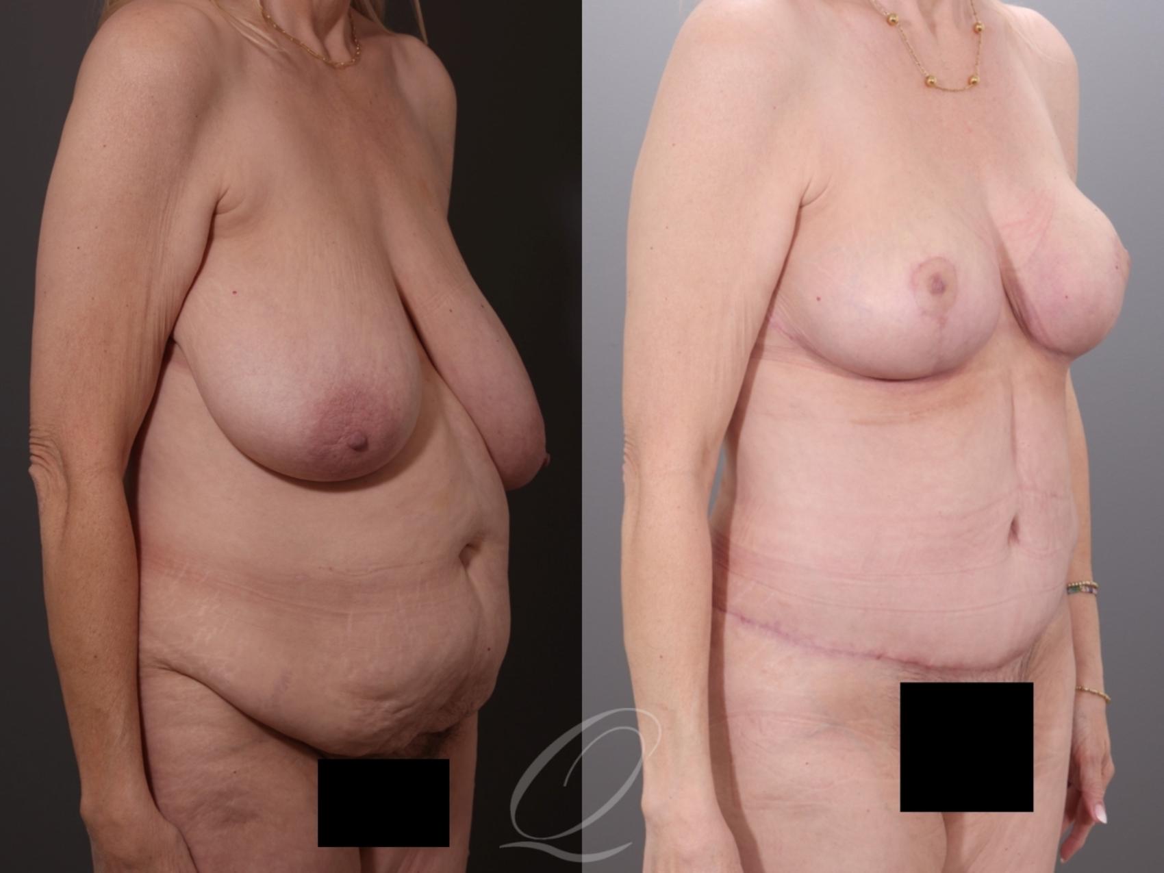 Mommy Makeover Case 1001994 Before & After Right Oblique | Serving Rochester, Syracuse & Buffalo, NY | Quatela Center for Plastic Surgery