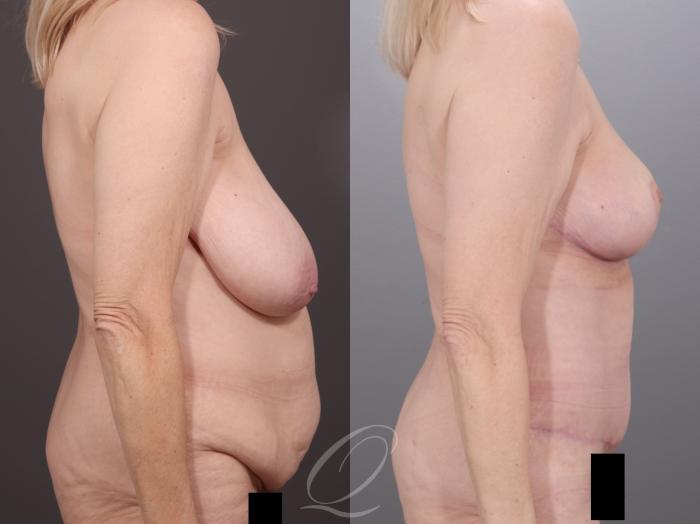 Mommy Makeover Case 1001994 Before & After Right Side | Serving Rochester, Syracuse & Buffalo, NY | Quatela Center for Plastic Surgery