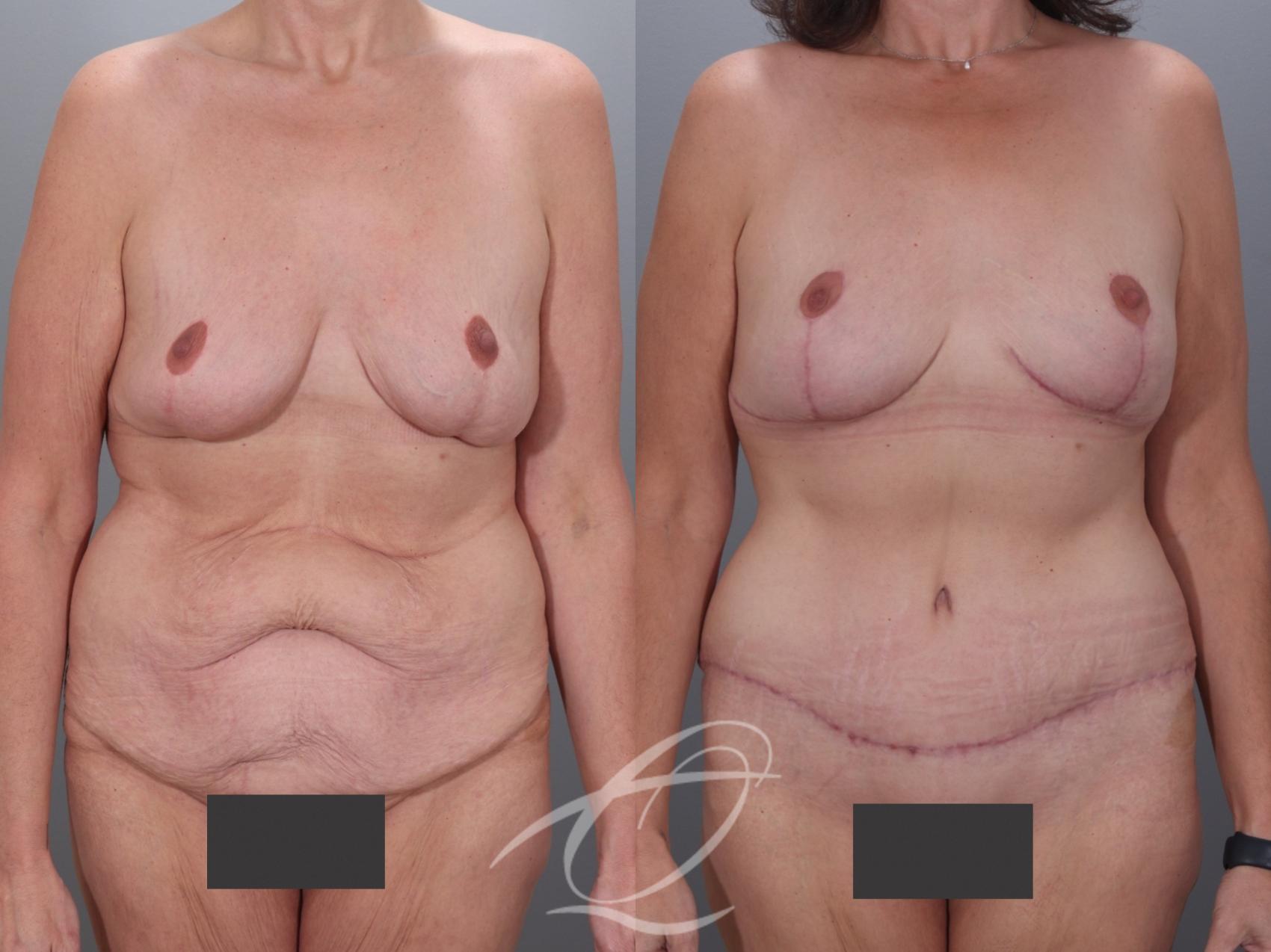 Mommy Makeover Case 1002079 Before & After Front | Serving Rochester, Syracuse & Buffalo, NY | Quatela Center for Plastic Surgery
