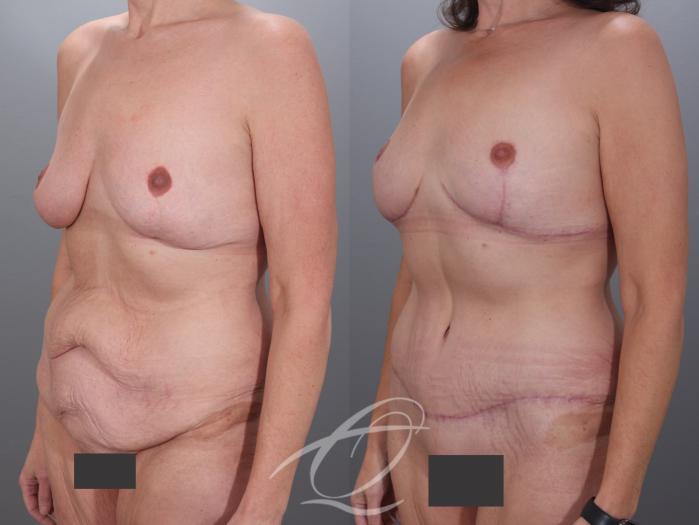 Mommy Makeover Case 1002079 Before & After Left Oblique | Serving Rochester, Syracuse & Buffalo, NY | Quatela Center for Plastic Surgery