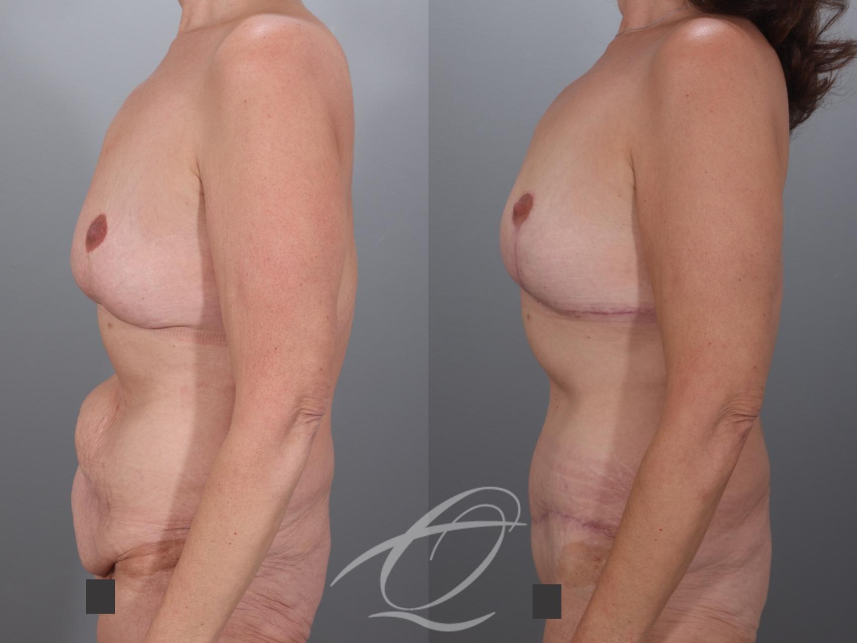 Mommy Makeover Case 1002079 Before & After Left Side | Serving Rochester, Syracuse & Buffalo, NY | Quatela Center for Plastic Surgery