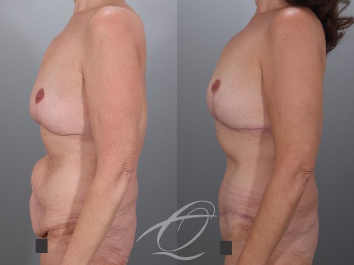 Mommy Makeover Case 1002079 Before & After Left Side | Serving Rochester, Syracuse & Buffalo, NY | Quatela Center for Plastic Surgery