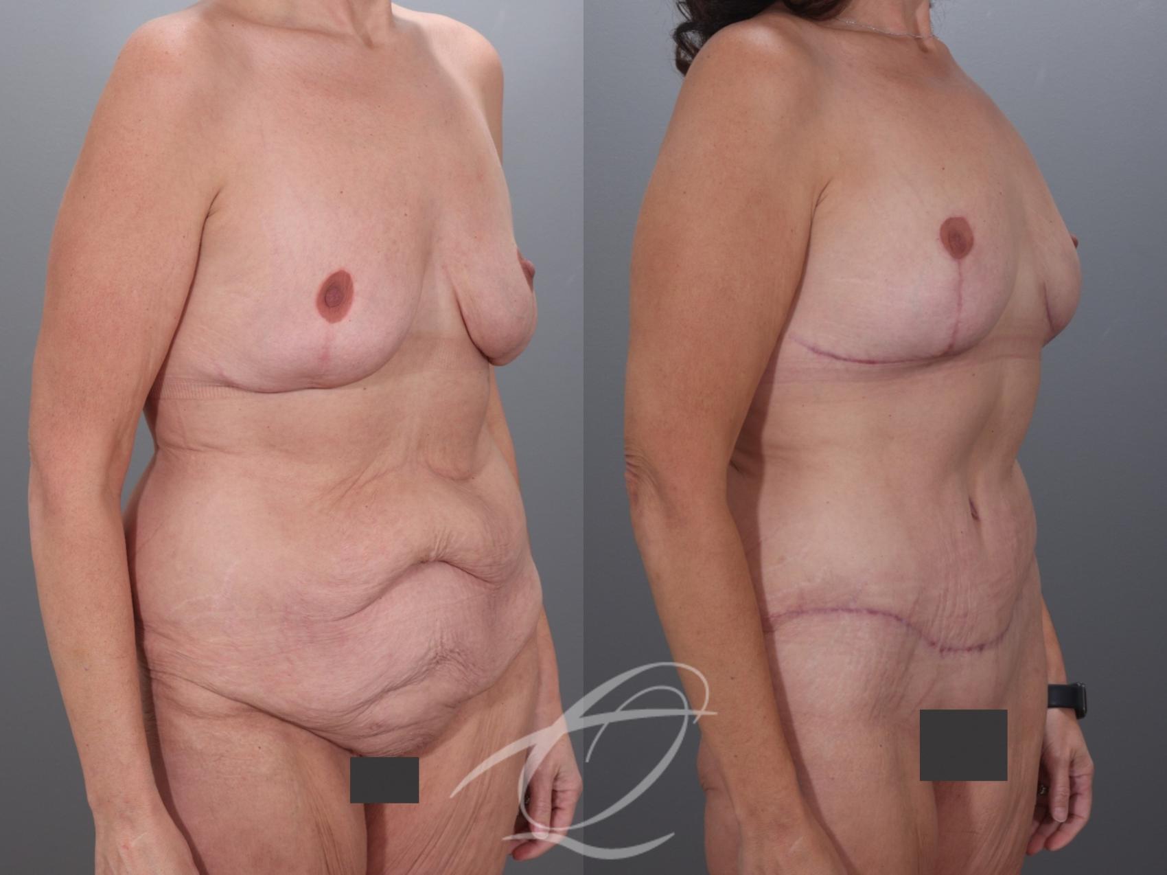 Mommy Makeover Case 1002079 Before & After Right Oblique | Serving Rochester, Syracuse & Buffalo, NY | Quatela Center for Plastic Surgery