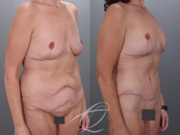 Mommy Makeover Case 1002079 Before & After Right Oblique | Serving Rochester, Syracuse & Buffalo, NY | Quatela Center for Plastic Surgery