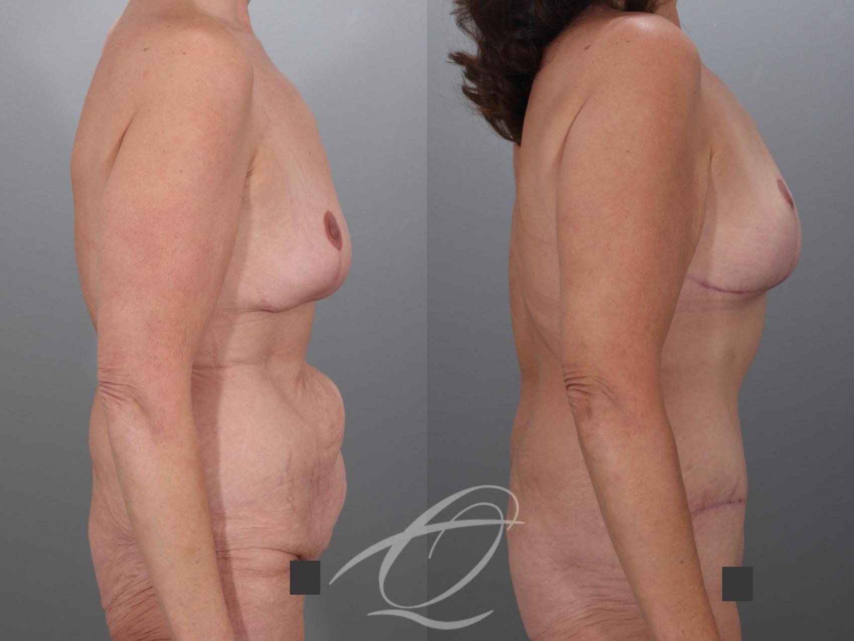 Mommy Makeover Case 1002079 Before & After Right Side | Serving Rochester, Syracuse & Buffalo, NY | Quatela Center for Plastic Surgery