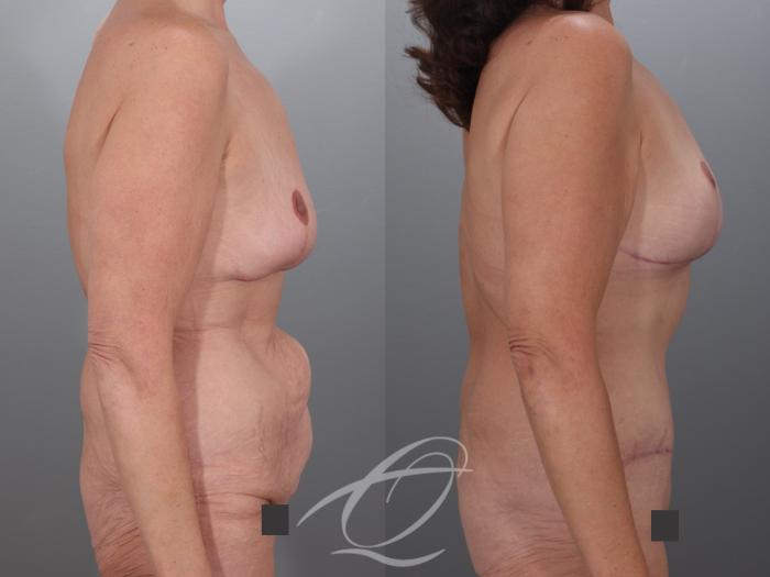 Mommy Makeover Case 1002079 Before & After Right Side | Serving Rochester, Syracuse & Buffalo, NY | Quatela Center for Plastic Surgery