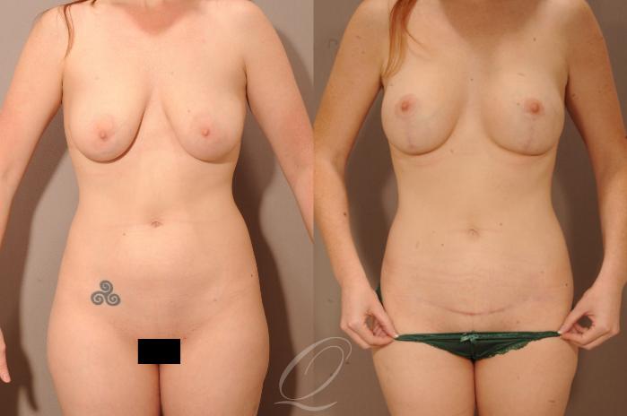 Breast Augmentation with Lift Case 1111 Before & After View #1 | Serving Rochester, Syracuse & Buffalo, NY | Quatela Center for Plastic Surgery