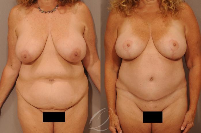 Mommy Makeover Case 1135 Before & After View #1 | Serving Rochester, Syracuse & Buffalo, NY | Quatela Center for Plastic Surgery