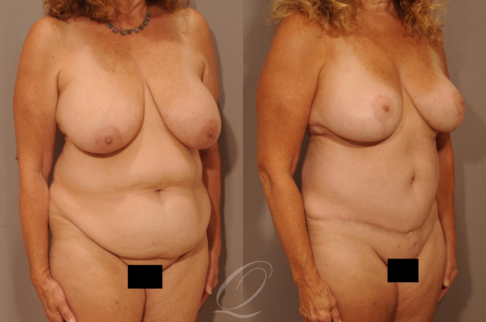 Mommy Makeover Before After Photos Patient 1135 Serving Rochester