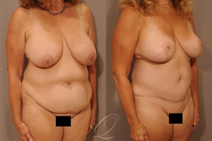 Mommy Makeover Case 1135 Before & After View #2 | Serving Rochester, Syracuse & Buffalo, NY | Quatela Center for Plastic Surgery